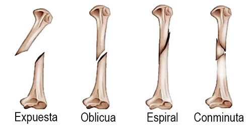 Tipos De Fracturas Oseas